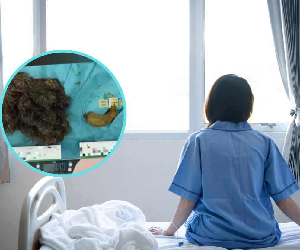 Z żołądka 14-latki lekarze usunęli 3 kg włosów. Nie było miejsca na jedzenie