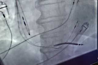 Kolejny sukces lekarzy z Gliwic. Wszczepili pacjentowi nowoczesny rozrusznik serca