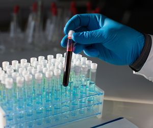Czerwienica (nadkrwistość) prawdziwa - przyczyny, objawy i leczenie