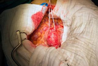Tętniak aorty brzusznej