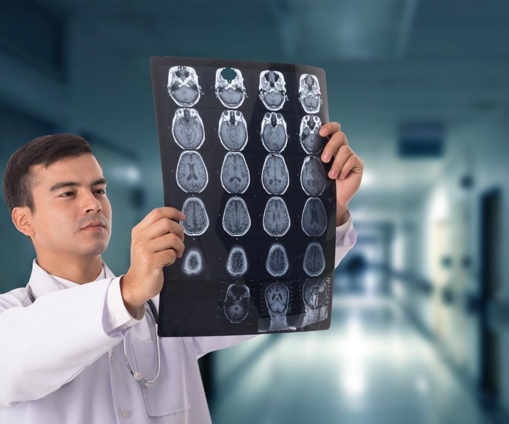 Udar mózgu może być objawem poważnej choroby krwi. Ekspert apeluje