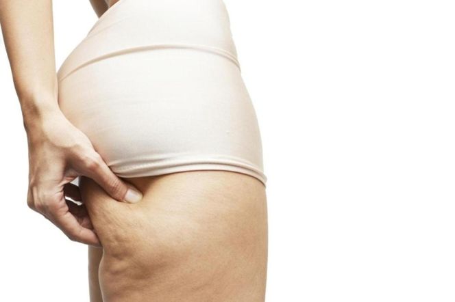 Cellulit - skąd się bierze? Jak określić stopnie cellulitu?
