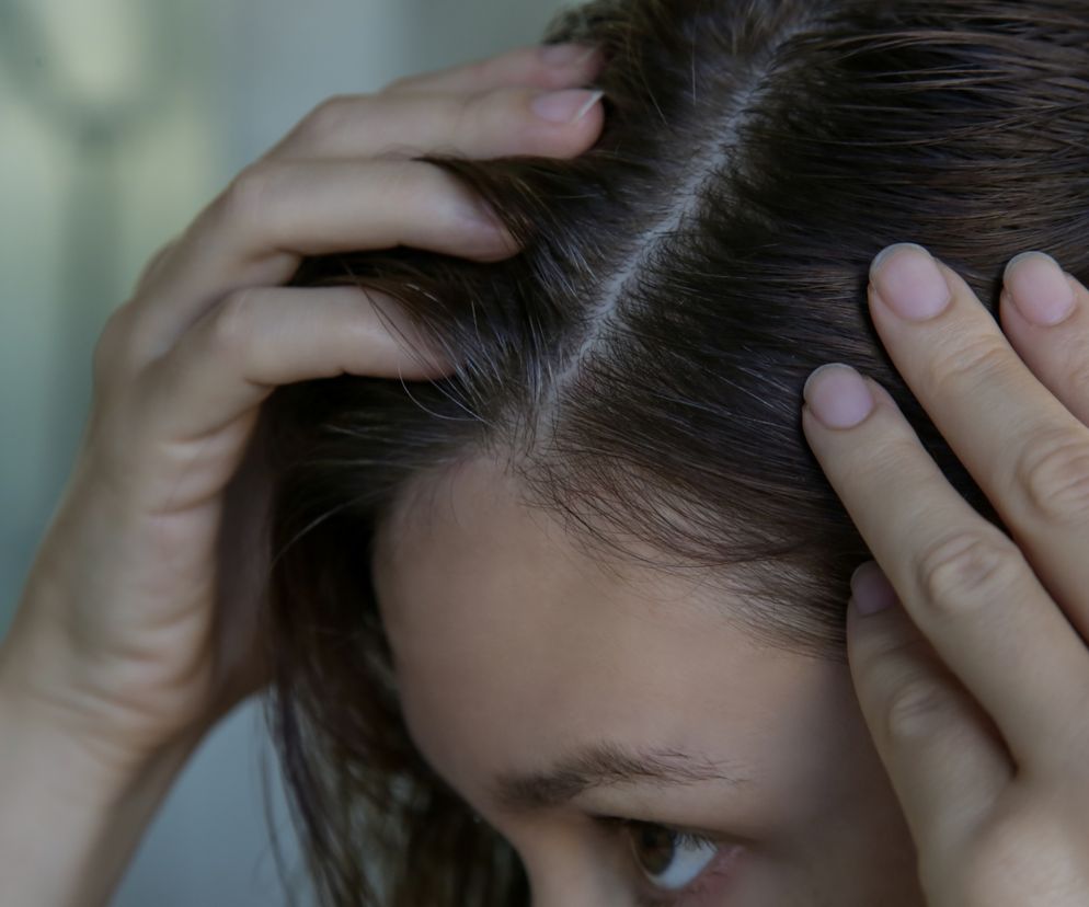 Przedwczesne siwienie - co je powoduje?