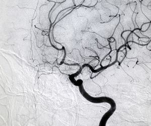 Angiografia tętnic wieńcowych: inwazyjne badanie serca