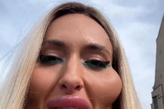 Ma największe policzki na świecie! I tak są za małe. Pokazała jak wyglądała kiedyś!