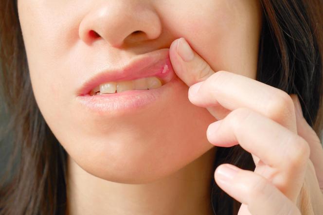 Afty w jamie ustnej – skąd się biorą i jak szybko się ich pozbyć?