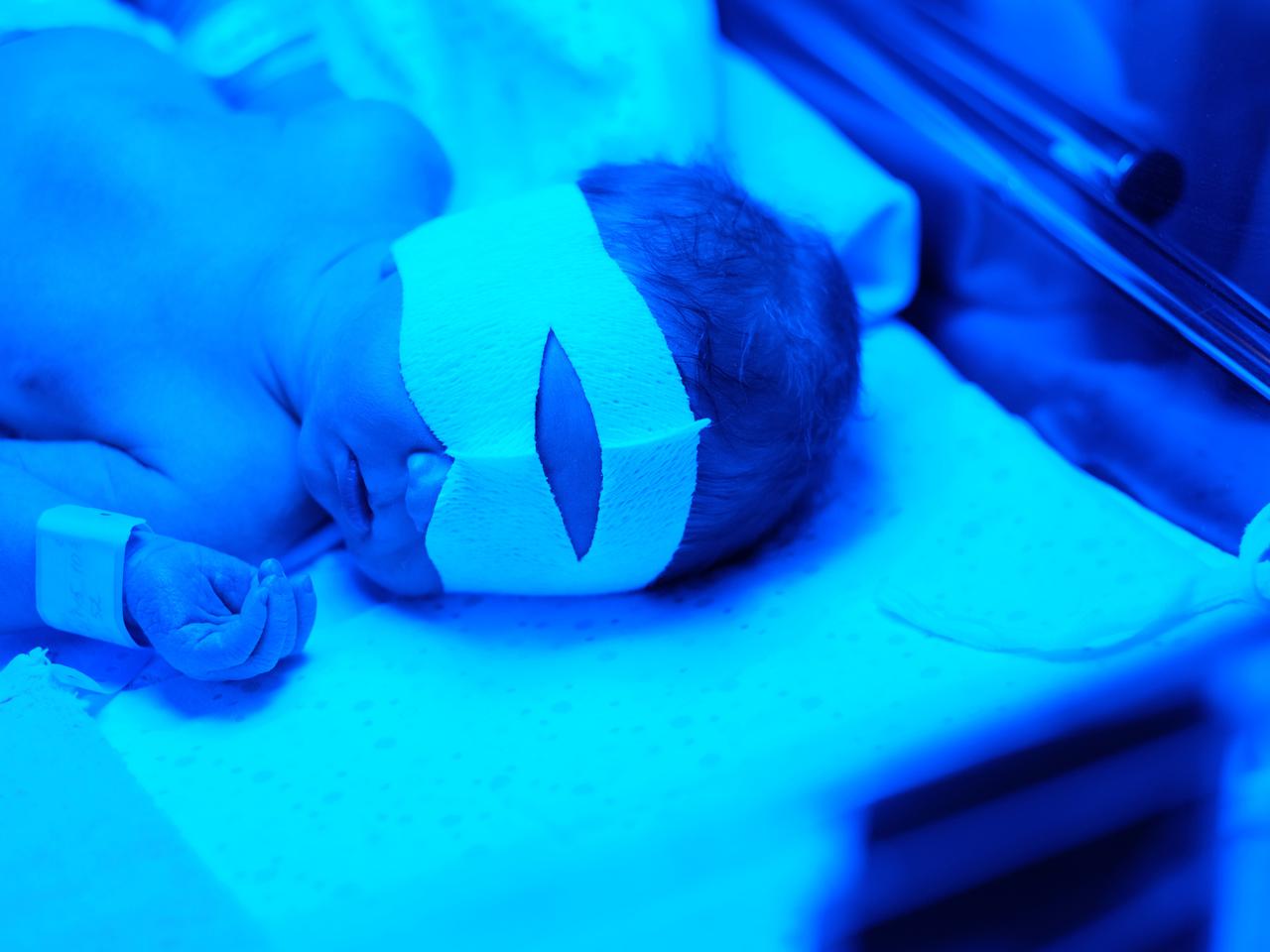 Czy mleko mamy nasila żółtaczkę? Dlaczego położne nie pozwalają karmić piersią naświetlanego dziecka?