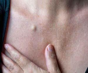 Wyciskasz, nakłuwasz, nacinasz, a kaszak ciągle ma się dobrze. Jak się go pozbyć, radzi dermatolog