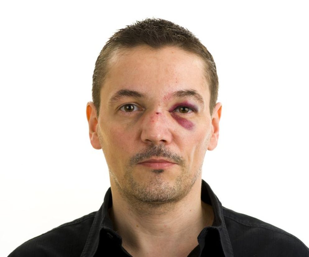 Jakie są objawy złamania nosa (z przemieszczeniem i bez przemieszczenia)?