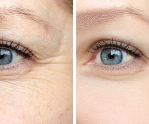 Zmarszczki pod oczami znikną. Dodaj 1 łyżkę i nałóż pod oczy, a skóra stanie się jędrna dzień po dniu