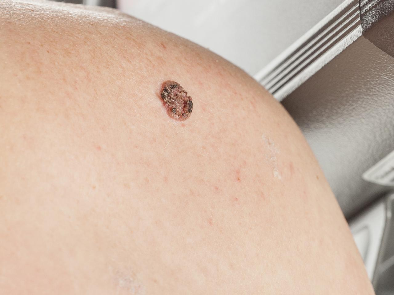 Ostrożnie z wystawianiem się na wiosenne SŁOŃCE. Farmaceuci z SUM OSTRZEGAJĄ