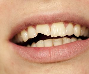 Złamany ząb - co robić, gdy ząb jest pęknięty, ukruszony, złamany?