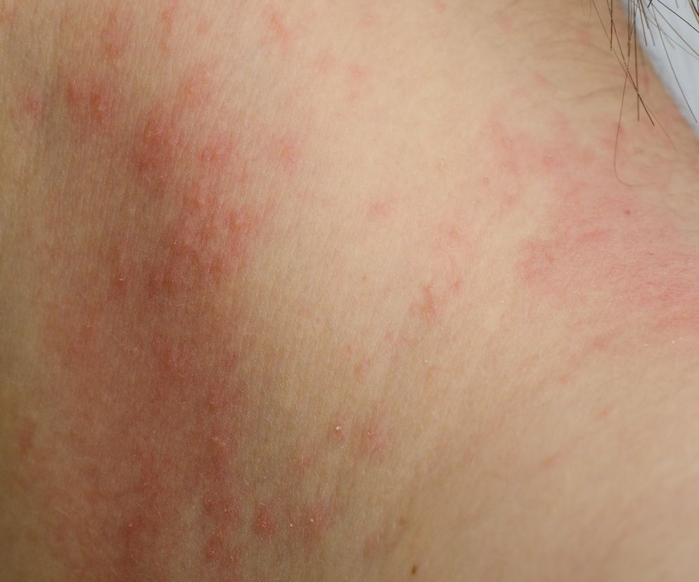 Kontaktowe zapalenie skóry - diagnostyka i leczenie. Jak zapobiegać wypryskowi kontaktowemu?