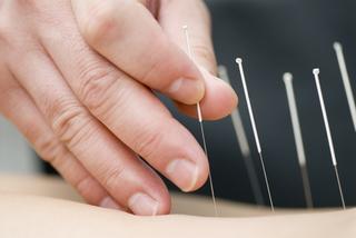 Znieczulenie za pomocą akupunktury – na czym polega znieczulenie porodu akupunkturą?