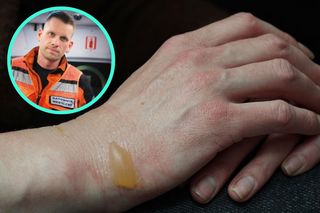 Nie przebijaj pęcherzy, wyrzuć maślankę. Ratownik ma lepszy sposób na oparzenia