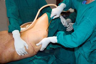 Miał być ślub, zmarła po zabiegu odsysania tłuszczu