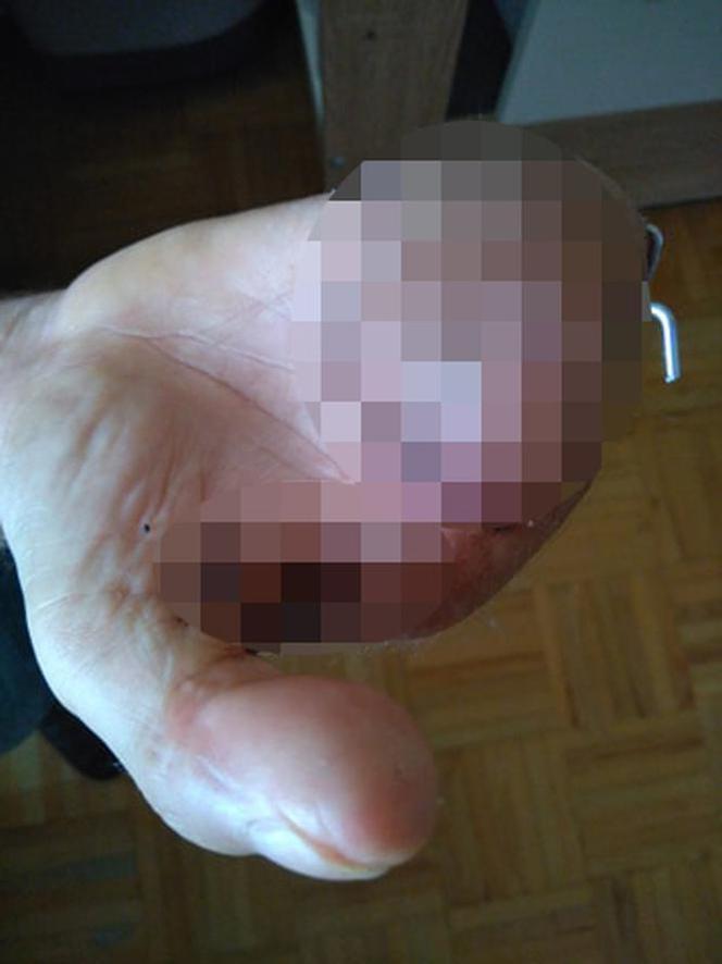 Maszyna zmiażdżyła palce