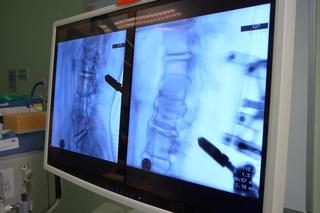 Ponad sto operacji kręgosłupów z udziałem robota w szpitalu wojewódzkim w Szczecinie