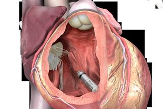 SERCE NA MIKROBATERIĘ