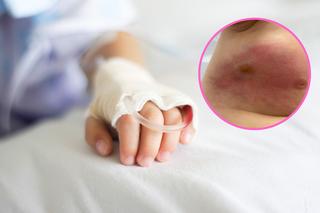 Pokazała powikłania po „niegroźnej” chorobie zakaźnej dziecka. „Tygodnie leczenia, dwie operacje”