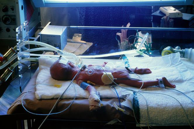 Pobite niemowlę, chore dziecko w szpitalu, inkubator