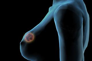 Rak piersi w wyniku rozrostu komórek przewodu mlecznego