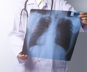 Rak płuc - przyczyny, objawy, diagnostyka