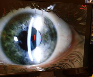 Szpital w Sosnowcu bije rekordy. To absolutny lider w przeszczepach rogówki w Polsce