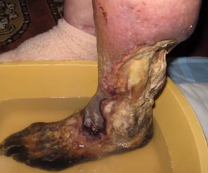 Krokodyl narkotyk i jego skutki (1)