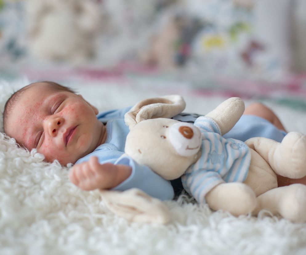 Dziecko leżące na łóżku smacznie śpi, krostki na jego buzi spowodowane są trądzikiem niemowlęcym. 