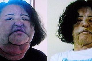 Hang Mioku, ofiary operacji plastycznych