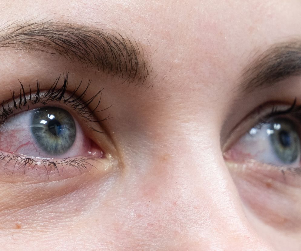 Boreliozę można zobaczyć w oczach? 5 objawów zdradza chorobę