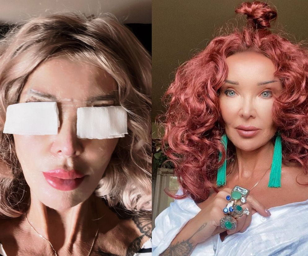 Ewa Minge Wycie a Powieki Mamy Drastyczne Zdj cie Zaraz Po Operacji 