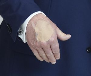 Donald Trump ma kłopoty ze zdrowiem. Nowe zdjęcia wywołały niepokój