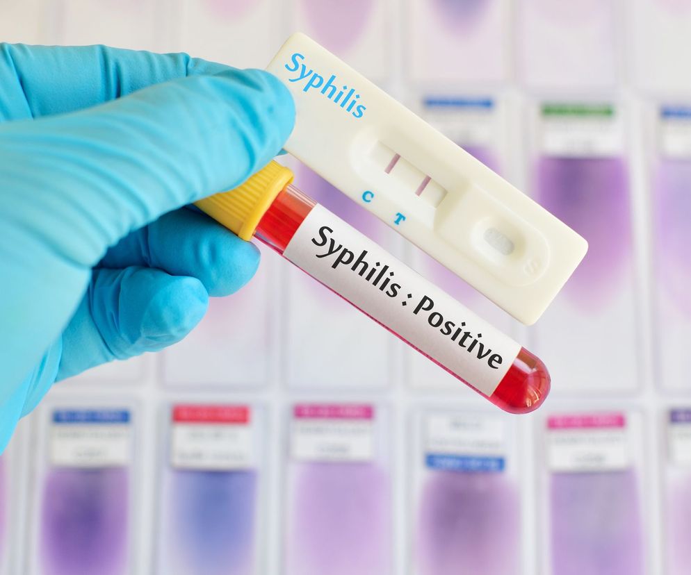 Kiła układu nerwowego przebiegać może różnie, czasami jej rozpoznanie bywa trudne - pierwotnie u pacjenta z kiłą układu nerwowego może być podejrzewany np. zespół otępienny.