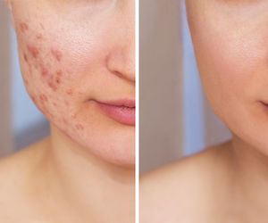 Na przebarwienia i trądzik. Kosztuje 15 zł, a działa jak zabieg za 400 zł