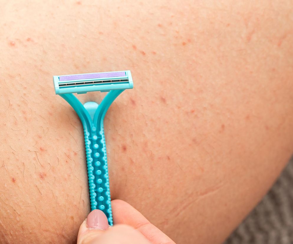 Letni koszmar okolic bikini. Jak się pozbyć brzydkich kropek po depilacji intymnej