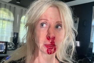 Ewa Gawryluk (Ewa z Pierwsza miłość) po wypadku na planie 