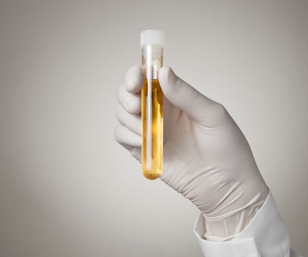 Rak prostaty: test moczu umożliwi wykrycie nowotworu