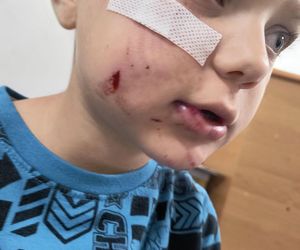 Pies pogryzł 4-letniego Frania. Chłopczyk w szpitalu, policja szuka właściciela