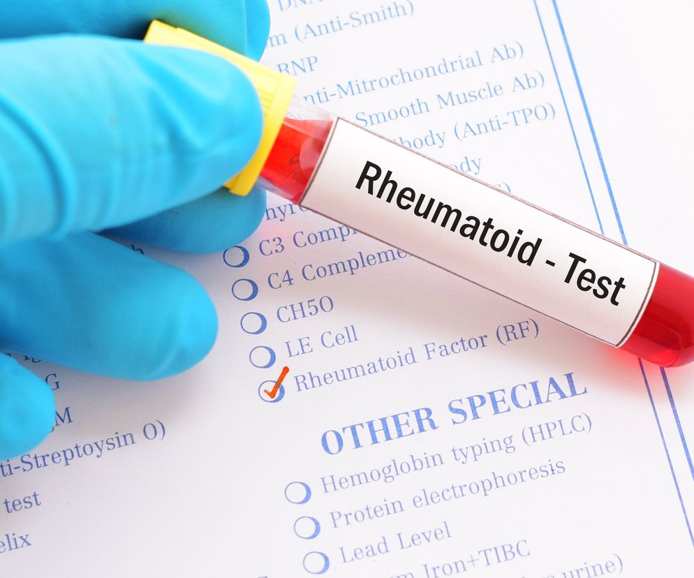 Czynnik reumatoidalny (ang. rheumatoid factor - RF) to przeciwciało, którego obecność możemy zaobserwować nie tylko w płynach ustrojowych osób chorych, ale także u zdrowych.