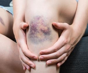 Robią ci się siniaki bez powodu? Koniecznie wykonaj te badania