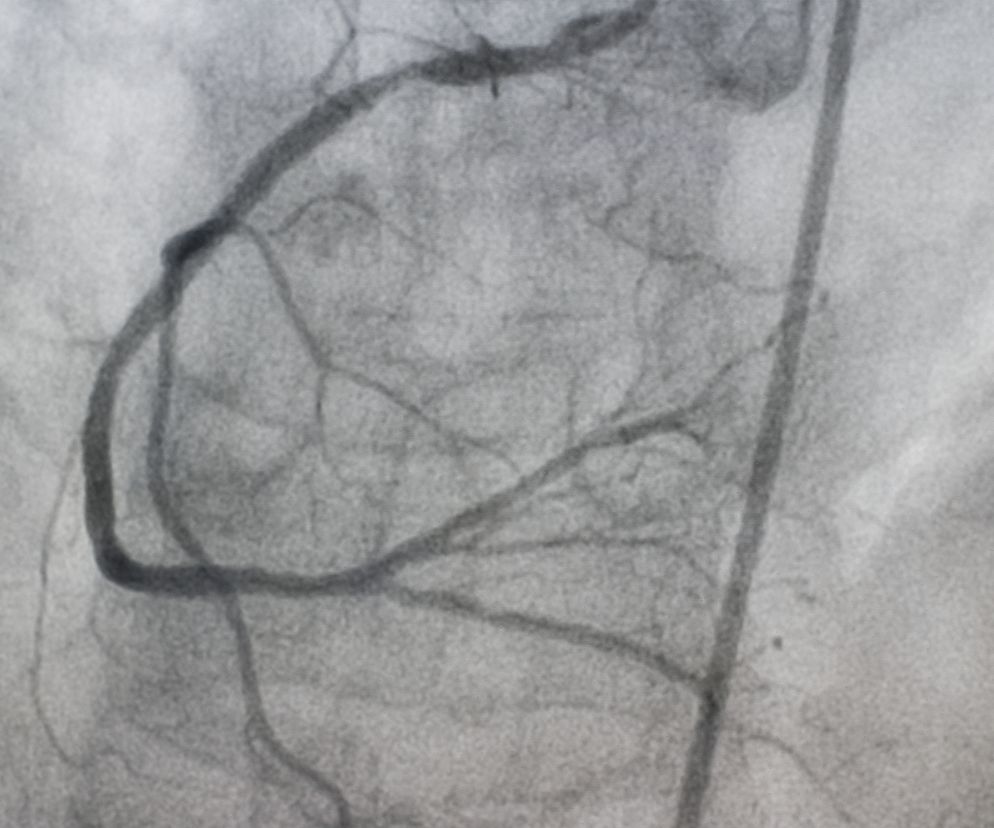 Arteriografia: badanie RTG tętnic