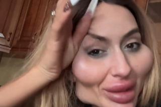 Ma największe policzki na świecie! I tak są za małe. Pokazała jak wyglądała kiedyś!