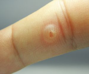 Brodawka wirusowa - czy jest zaraźliwa? Jak wyleczyć brodawki wirusowe?