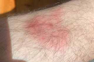 Rumień wędrujący to jeden z pierwszych i najbardziej rozpoznawalnych objawów boreliozy