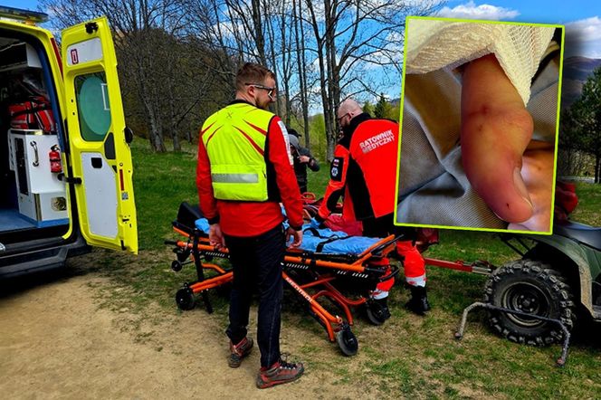 Turysta ukąszony przez żmiję.