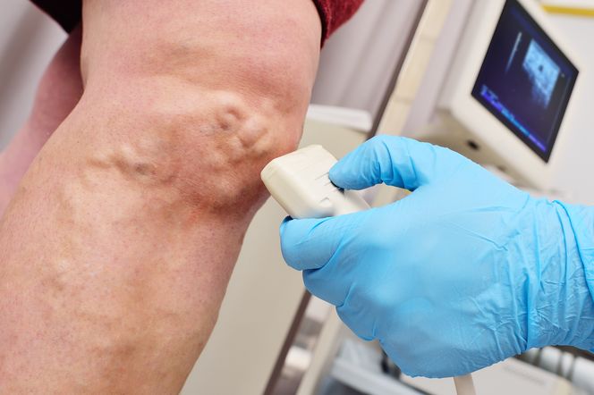 To może zmienić sposób leczenia miażdżycy. Jeden czynnik ważniejszy, niż cholesterol