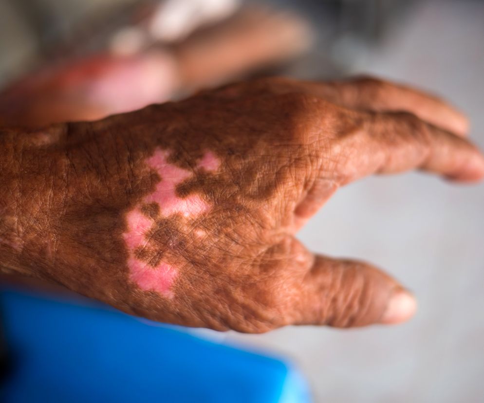 Coraz więcej przypadków trądu. Źródło zakażeń nieznane