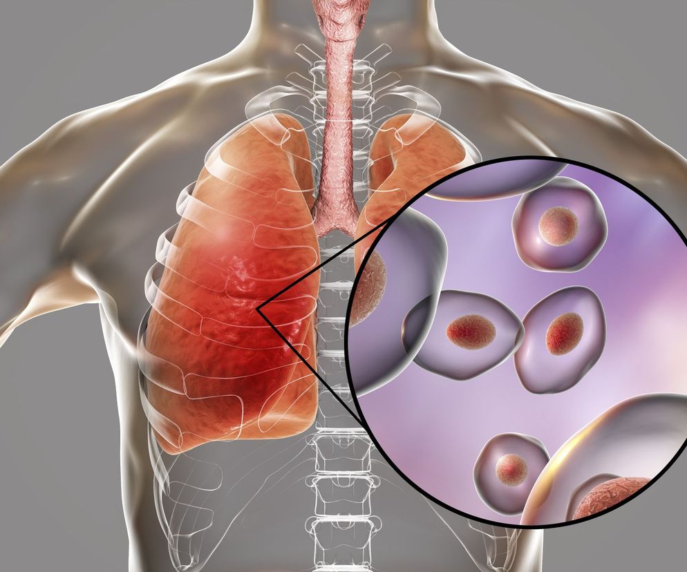 Pneumocystis carinii (właściwie pneumocystis jiroveci) u osób z obniżoną odpornością wywołuje groźne pneumocystozowe zapalenie płuc.